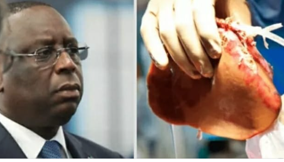 Transplantation rénale au Sénégal : Macky salue une première